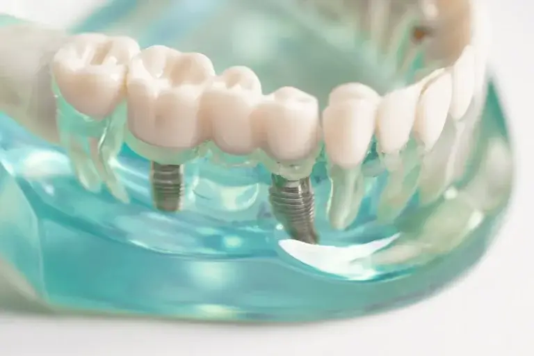 Dental Implants in Tijuana Mexico