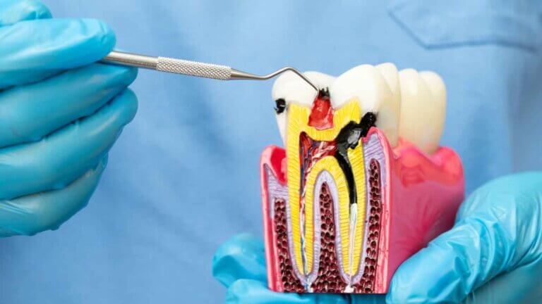 Root Canal Treatment in Tijuana Mexico