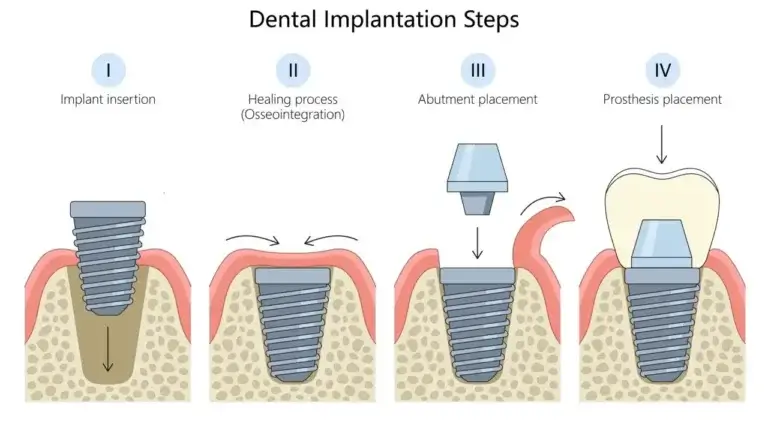 Dental Implants in Tijuana Mexico