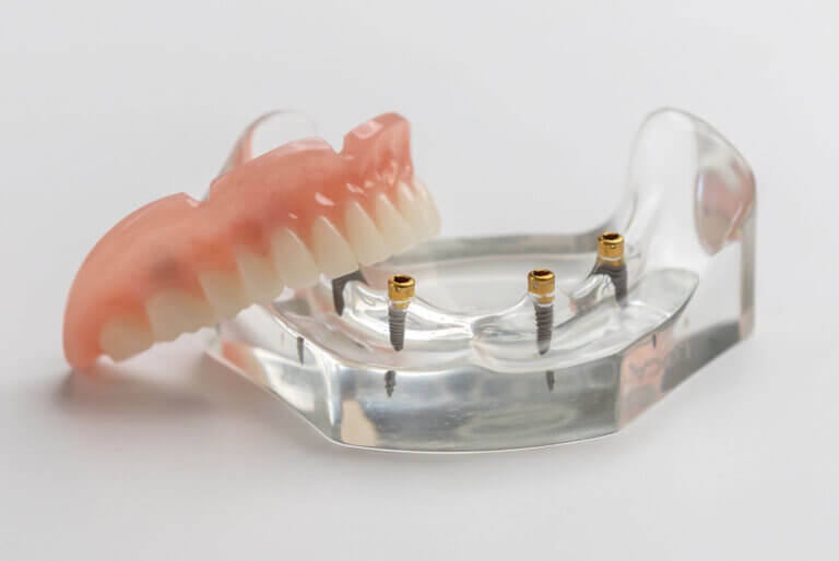 All-on-4 dental implants in Tijuana