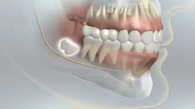 Wisdom Teeth Removal in Tijuana Mexico