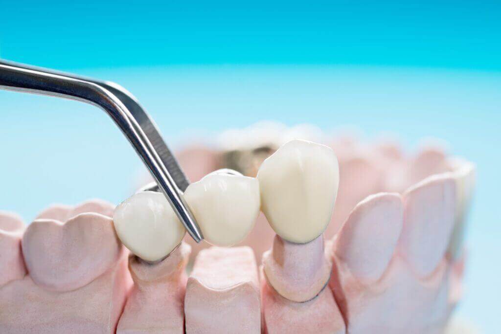 Dental Bridges in Tijuana Mexico