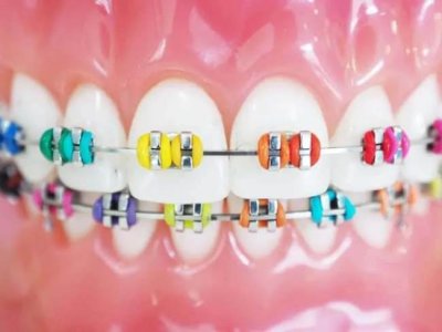 Braces
