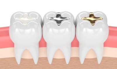 Composite Fillings