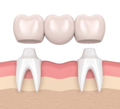 Los Puentes Dentales