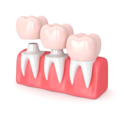 Dental Crowns