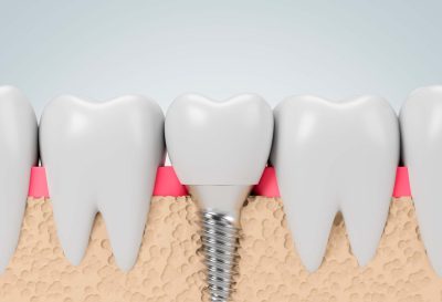 Implantes Dentales