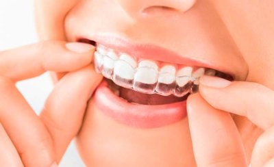 Invisalign