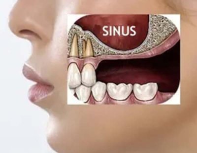 Sinus Lift Surgery