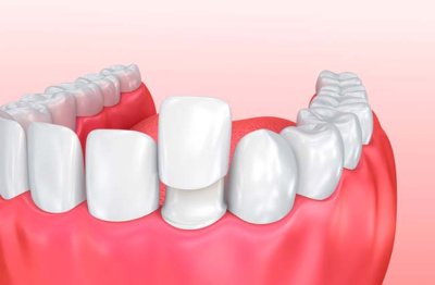 Veneers